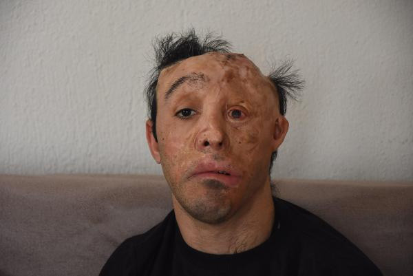 Mehmet Ali'nin ameliyatları koronaya takıldı - Resim: 1