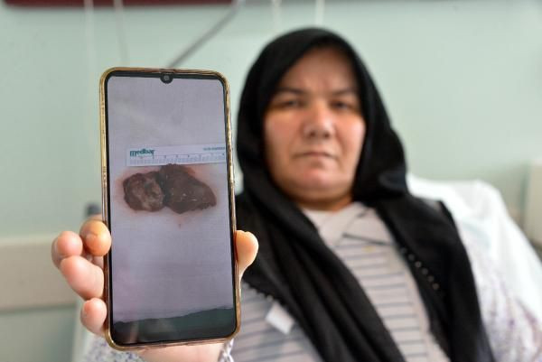 Kahramanmaraş'ta 55 yaşındaki kadının kalbinden 7 santim tümör çıkarıldı - Resim: 1