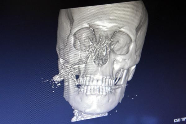 Kahramanmaraş'ta demir kesmek istedi bu hale geldi! Parçalanan yüzü vida ile onarıldı - Resim: 3