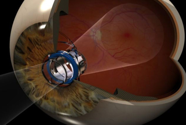 Göz bozukluğuna 'teleskop' mucizesi - Resim: 2