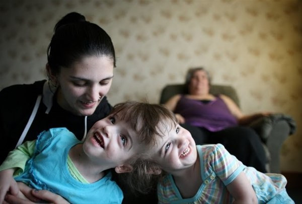 Bu halde dünyaya geldiler 'benzersiz ikizlere' bakın ölene kadar... - Resim: 3