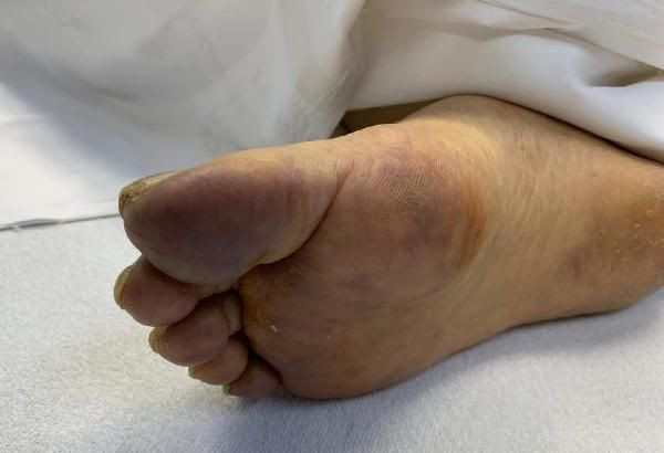 Cerrahpaşa'da çekildi! Derideki kızarıklık, kurdeşen ve kaşıntı koronavirüs belirtisi mi? - Resim: 4