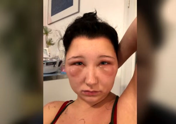 Saç boyası genç kızı öldürüyordu yaşadıkları şeyler ve görüntüsü korkunç - Resim: 4