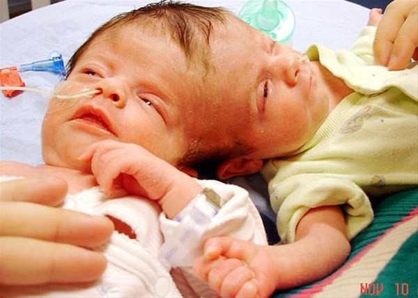 Bu halde dünyaya geldiler 'benzersiz ikizlere' bakın ölene kadar... - Resim: 1