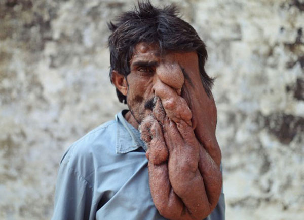 Hindistan'ın Fil Adamı Chana Lal - Resim: 1