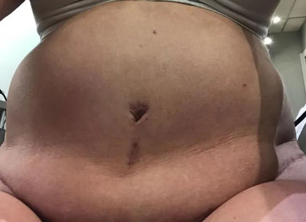 'Vücudun kum saati gibi olacak' denilmişti! Oturamaz hale geldi - Resim: 0