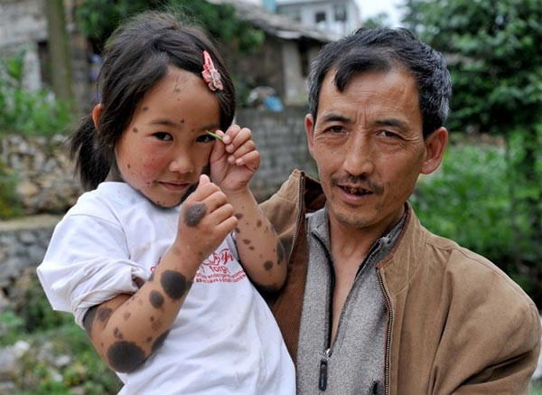 Kurt kızın dramı - Resim: 1