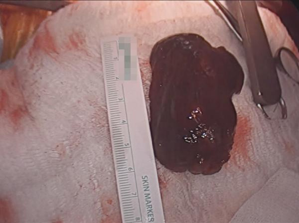 Kovid sanıldı! Kalbinin yarısı büyüklüğünde tümör çıktı - Resim: 0