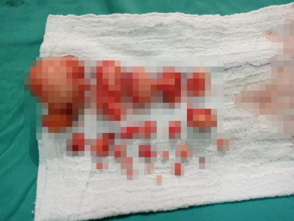 Malatya'da ağrı şikayetiyle hastaneye gitti! Doktorlar şaştı kaldı: Bunlar çok belirti vermez - Resim: 1