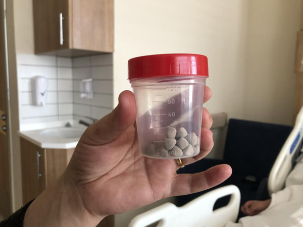 İdrarda zorlanma şikayetiyle hastaneye gitti! Mesanesinden çıkanları görünce inanamadı: Tespih yapacak - Resim: 1