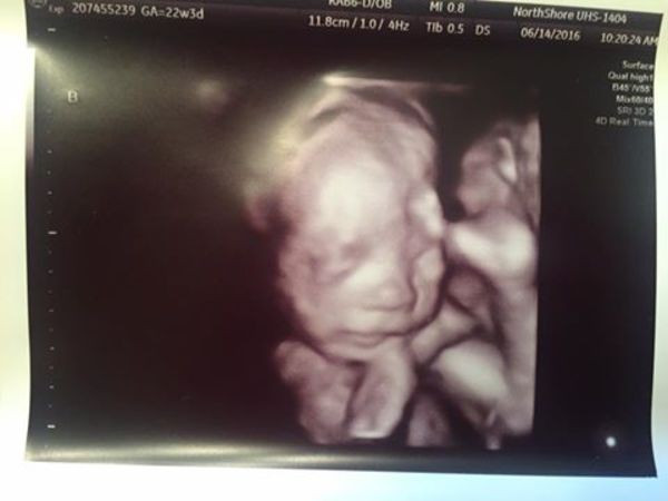 Eşi vefat ettikten sonra hamile olduğunu öğrendi ultrasonda müjdeyi aldı - Resim: 4