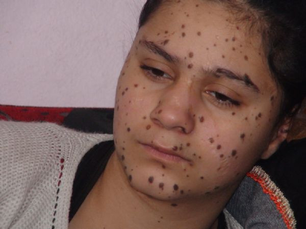 Cilt kanserine yakalandı - Resim: 1