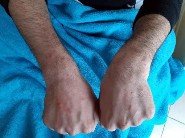 Cerrahpaşa'da çekildi! Derideki kızarıklık, kurdeşen ve kaşıntı koronavirüs belirtisi mi? - Resim: 2