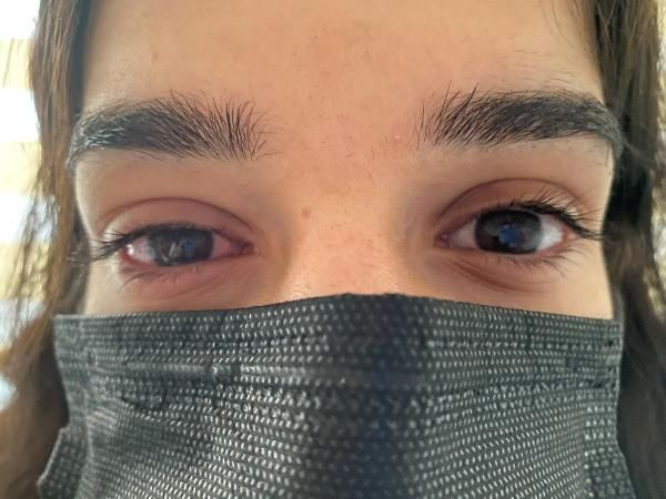 Korona bitmeden gözlerde virüs salgını başladı! Adenovirüs nedir kör eder mi? - Resim: 2