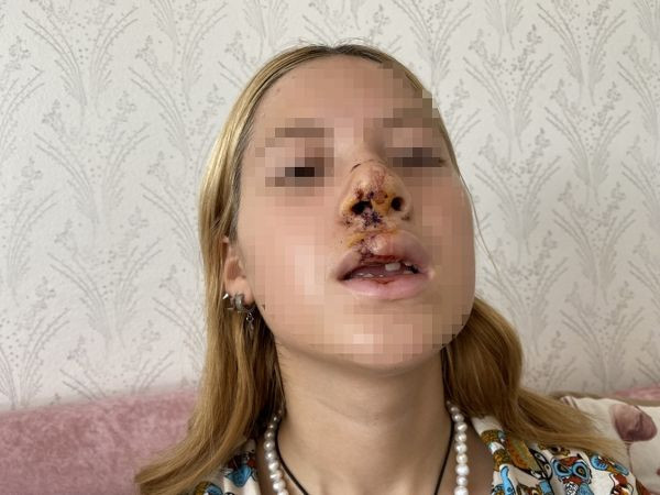 Tacizciler yüzüne kaldırım taşı fırlatmıştı!  O genç kız ilk kez konuştu - Resim: 3