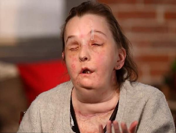 Kocası yüzüne kimyasal madde attı ikinci kez yüz nakli yapıldı! İşte son hali - Resim: 0