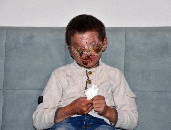 Erzurumlu 8 yaşındaki Salih güneşe çıkabilecek! Cilt kanseri yüzünü bu hale getirmişti - Resim: 1