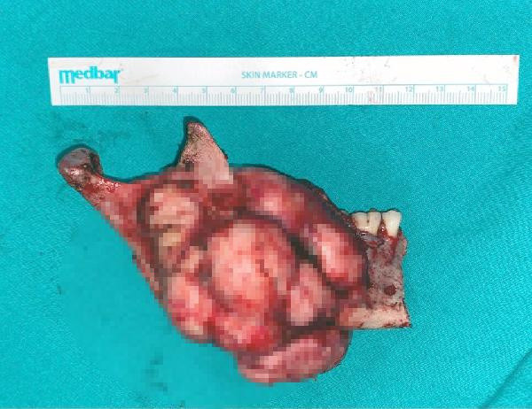 Türkiye'de ilk kez yapıldı! Dişleri yamuldu yemek yiyemez hale gelmişti - Resim: 2