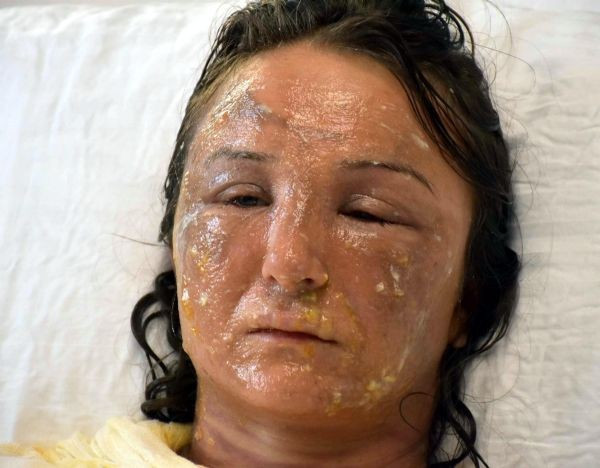 Kaynana dehşeti! Gelinin yüzüne kızgın yağ döktü - Resim: 1