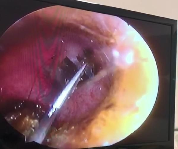 Kulağı ağrımaya başlayınca doktora gitti! Kulağından çıkan canlı herkesi şaşırttı - Resim: 1