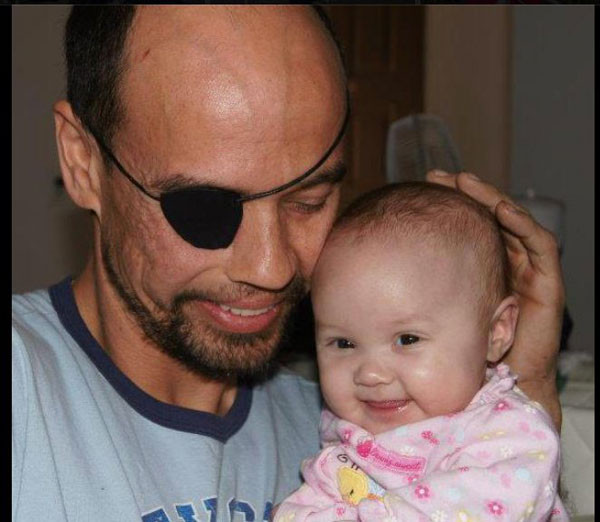 Bu adam yüzünün yarısı olmadan yaşıyor - Resim: 3