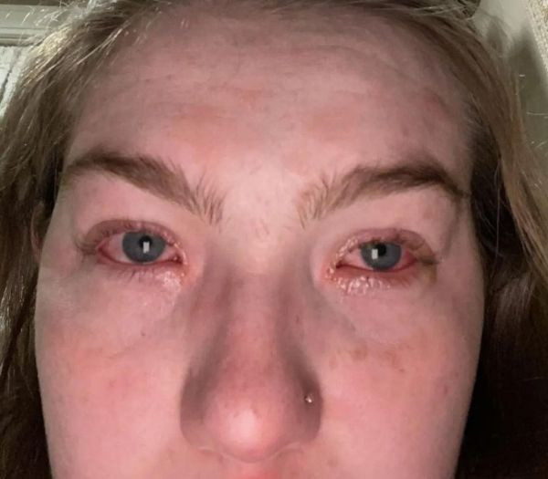 Erkek arkadaşınıza alerjiniz olabilir! Genç kadının ilginç hikayesi: Hastanelik bile oldu! - Resim: 4