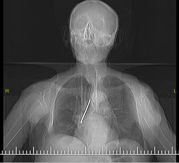 Elazığ'da yaşlı adamın boğazından 10 Santimetrelik çivi çıkarıldı - Resim: 1