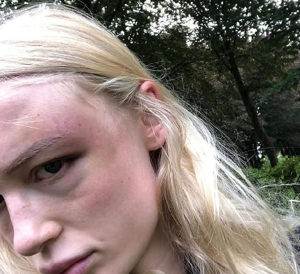 Belçikalı model Anthonia Rochus sevgilisinden gördüğü şiddeti fotoğraflarla belgeledi - Resim: 2