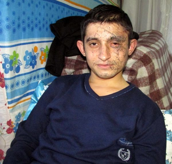 Kayseri'de yaralanan asker o anları anlattı! - Resim: 2