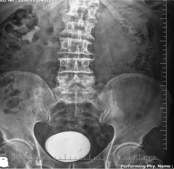 Ordu'da idrar yanmasıyla gitti! Mesanesinden öyle bir şey çıktı ki gören inanamadı: Çok nadir görülüyor - Resim: 1