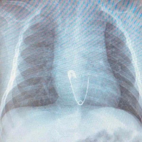 Elazığ'da 15 dakikalık operasyonla çıkarıldı! 5 aylık bebek ölümden döndü - Resim: 0