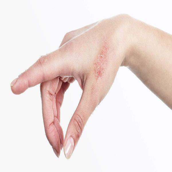 Sedef hastalığı olanlar dikkat! Yaz sıcakları sizler için riskli olabilir - Resim: 2