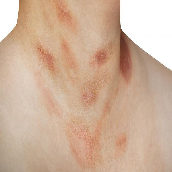 Sedef hastalığı olanlar dikkat! Yaz sıcakları sizler için riskli olabilir - Resim: 4