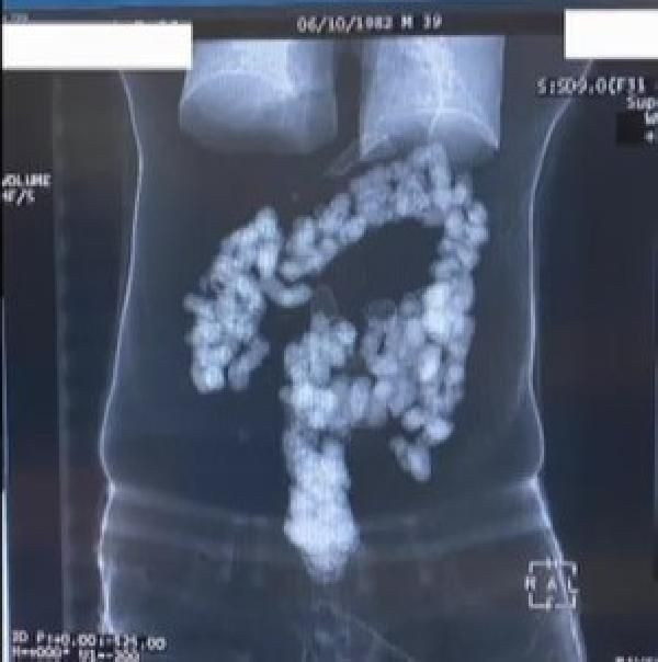 İstanbul Havalimanı'nda gözaltına alındılar! 2 yolcunun midesinden 244 kapsül eroin çıktı - Resim: 3
