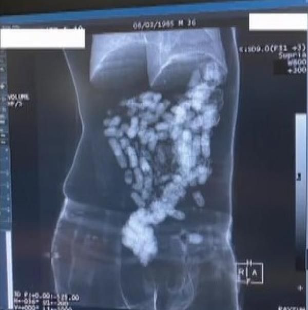 İstanbul Havalimanı'nda gözaltına alındılar! 2 yolcunun midesinden 244 kapsül eroin çıktı - Resim: 4