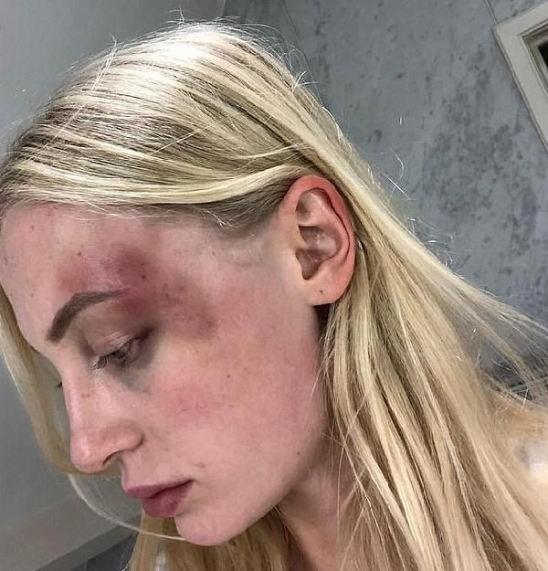 Belçikalı model Anthonia Rochus sevgilisinden gördüğü şiddeti fotoğraflarla belgeledi - Resim: 4