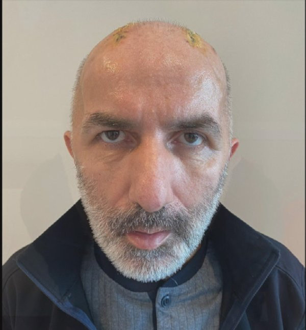 Her şey 6 ay önce oldu! İstanbul'da kafatası kemiklerini karnında taşıdı: Asıl kabus daha sonra başladı - Resim: 4