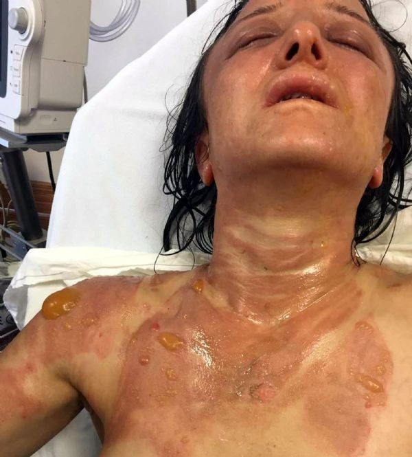 Kaynana dehşeti! Gelinin yüzüne kızgın yağ döktü - Resim: 3