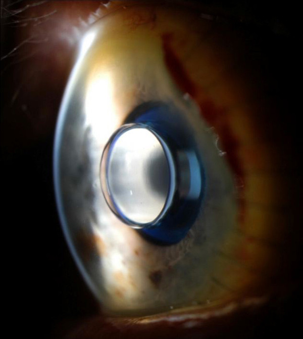 Göz bozukluğuna 'teleskop' mucizesi - Resim: 3