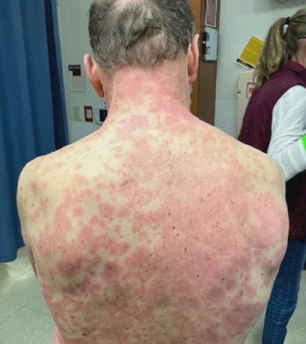 ABD'de Johnson&Johnson aşını vurulan kişide 'yan etki' kabusu - Resim: 0