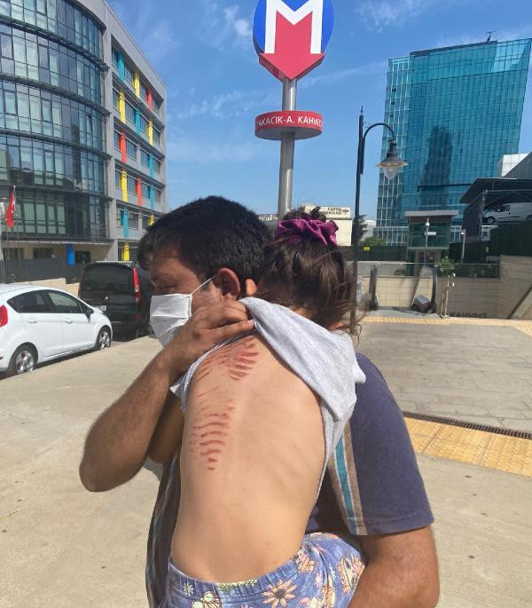 Metroda saçları merdivene sıkışmıştı! İşte Berfin'in son durumu - Resim: 0