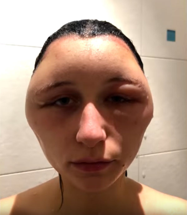 Saç boyası genç kızı öldürüyordu yaşadıkları şeyler ve görüntüsü korkunç - Resim: 3