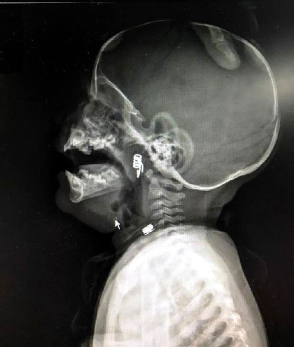 1 yaşındaki bebeğin yuttuğu şeye inanamayacaksınız filmde göründü... - Resim: 2