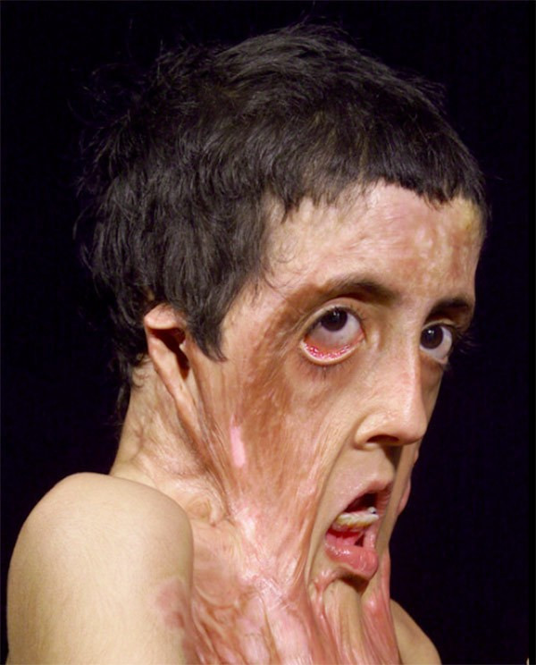 9 yaşındaki kızın yüzünde soba patladı son halini görünce... - Resim: 1