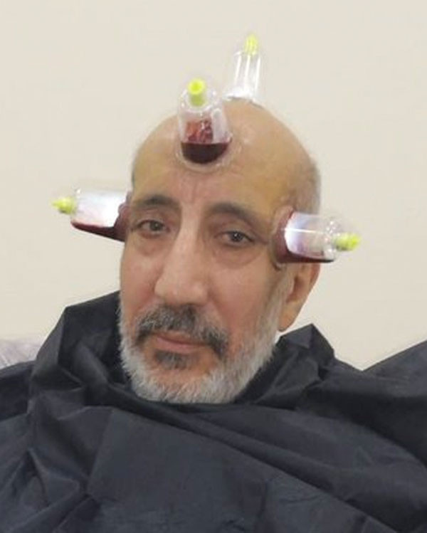 Abdurrahman Dilipak kendine ne yapmış öyle göz için hacamat yapılır mı? - Resim: 3