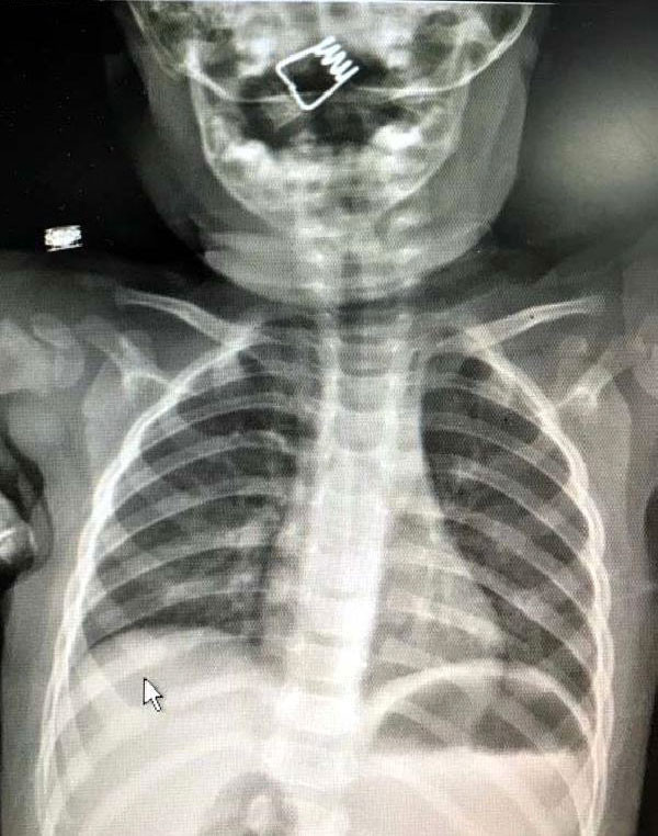 1 yaşındaki bebeğin yuttuğu şeye inanamayacaksınız filmde göründü... - Resim: 3