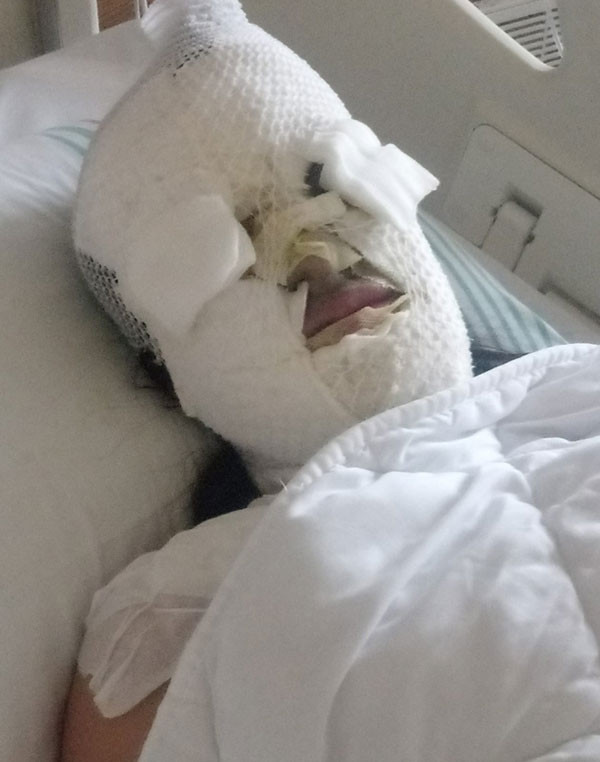 Hatay'da yüzü yakılan  Berfin Özek'ten kötü haber! Gözünü kaybedebilir - Resim: 4