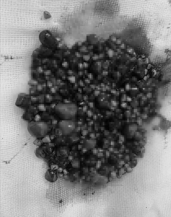 Antalya'da karın ağrısı şikayetiyle gitti, safra kesesinden çıkanları gören şaşkına döndü! - Resim: 0