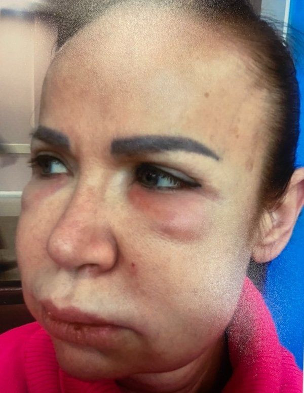 İstanbul'da estetik faciası! Lise mezunu doktor (!) tanınmaz hale getirdi - Resim: 2
