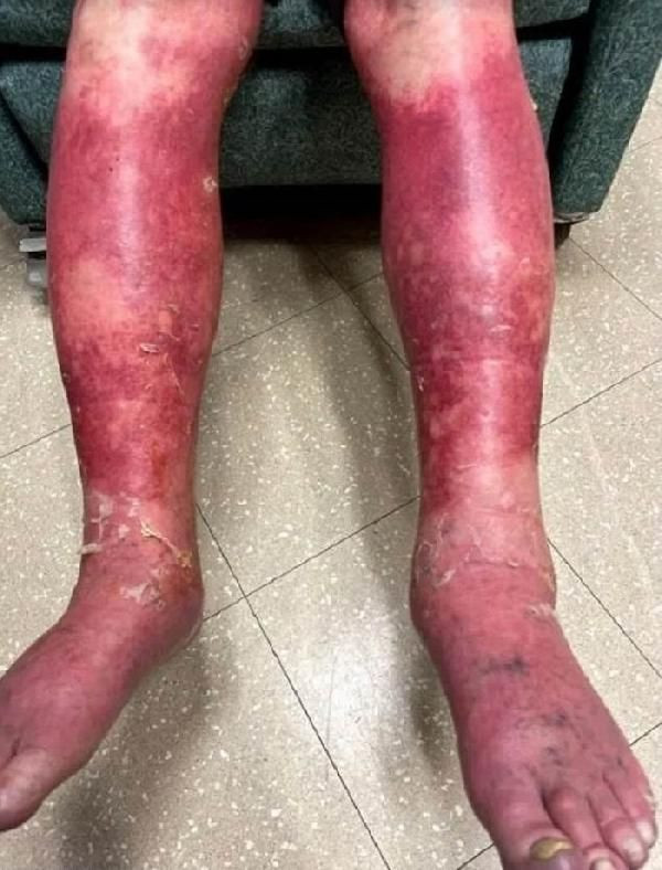 ABD'de Johnson&Johnson aşını vurulan kişide 'yan etki' kabusu! Vücudu döküldü - Resim: 2